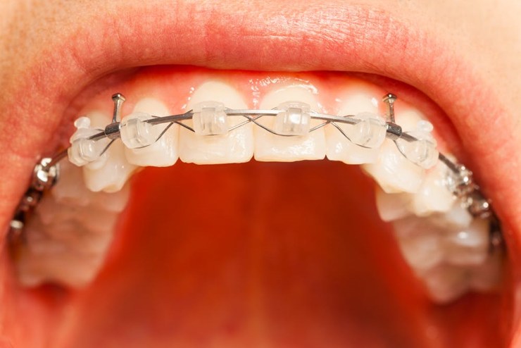 crooked teeth causes टेढ़े-मेढ़े दांत